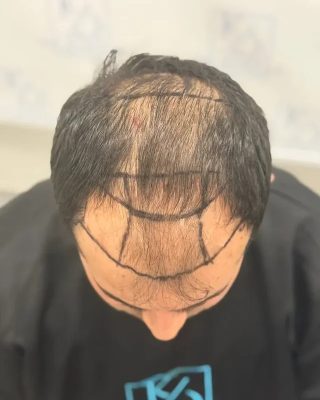 ÖNCESİ