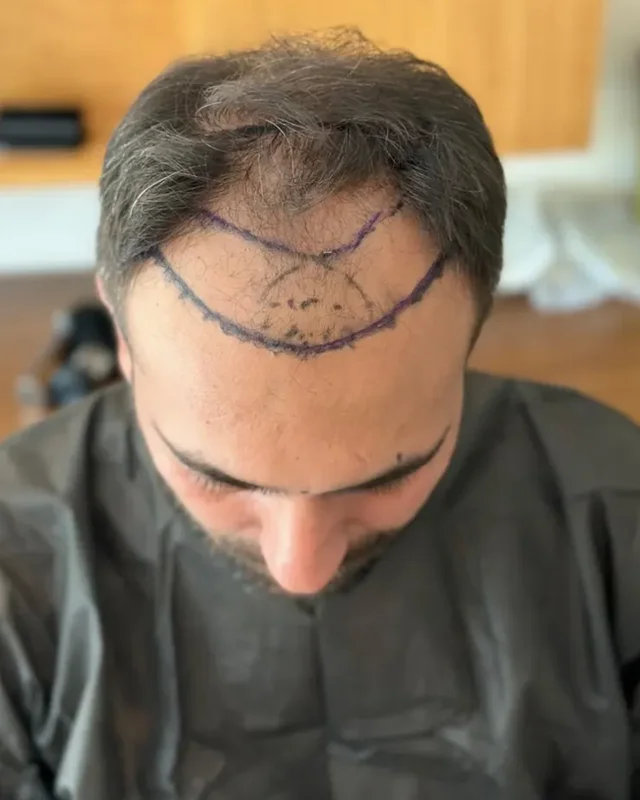 ÖNCESİ