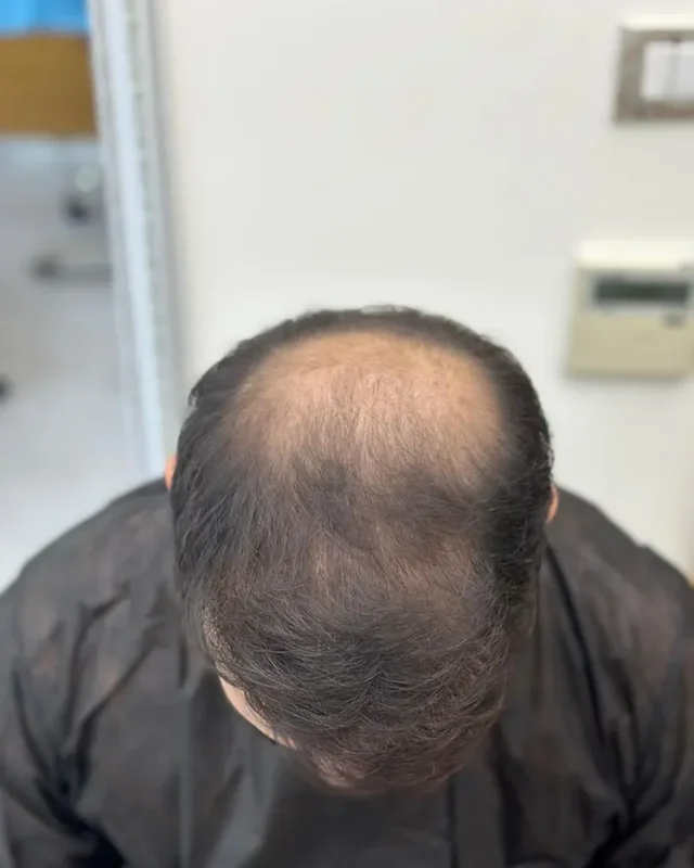 ÖNCESİ