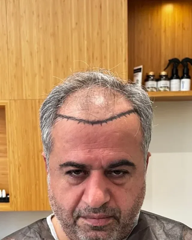 ÖNCESİ