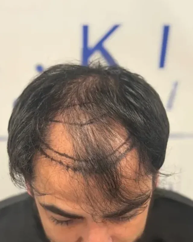 ÖNCESİ