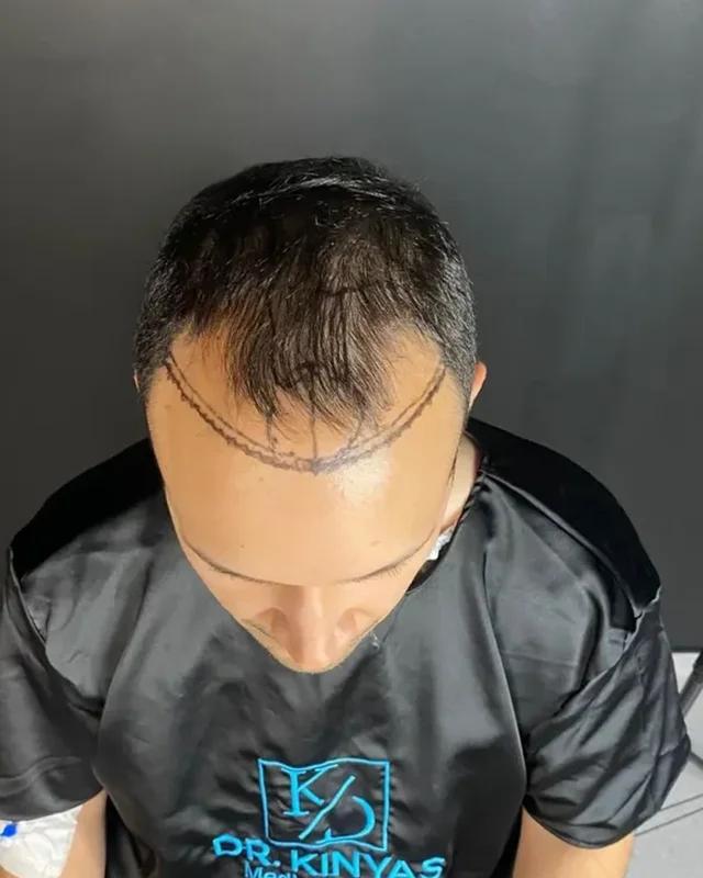 ÖNCESİ