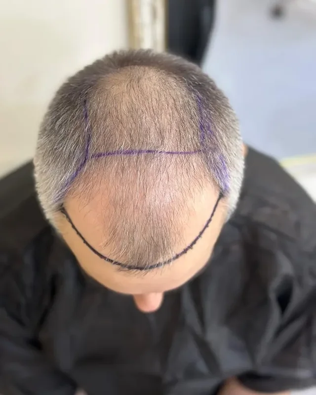 ÖNCESİ