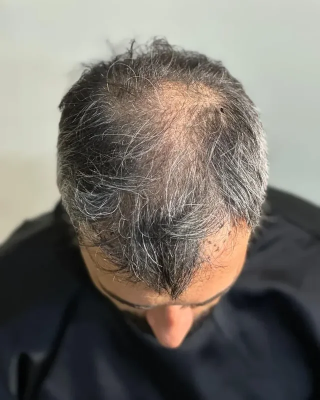 ÖNCESİ