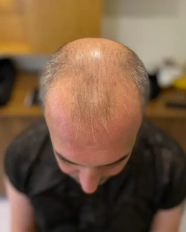ÖNCESİ