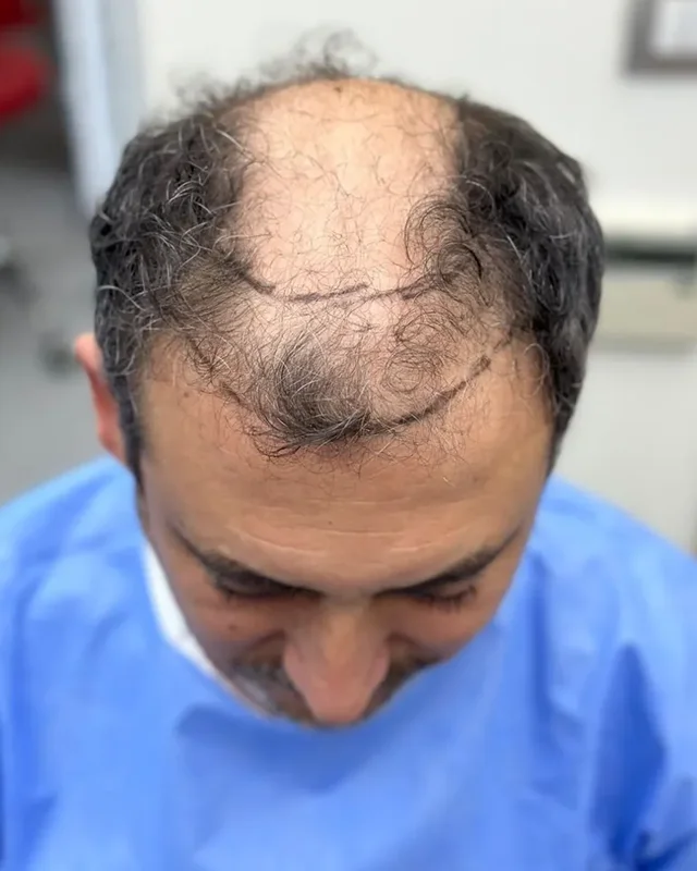 ÖNCESİ