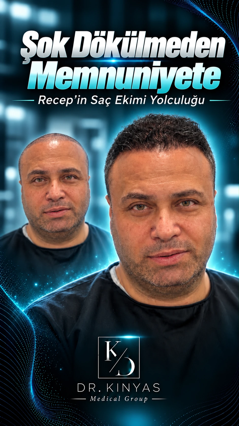 Şok Dökülmeden Memnuniyete · Recep’in Saç Ekimi Yolculuğu