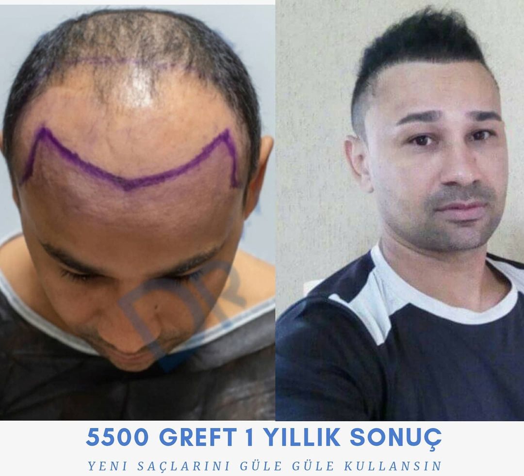 5500 GRAFT 1-YEAR RESULTS