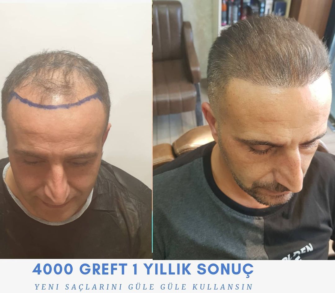 4000 GRAFT 1-YEAR RESULTS