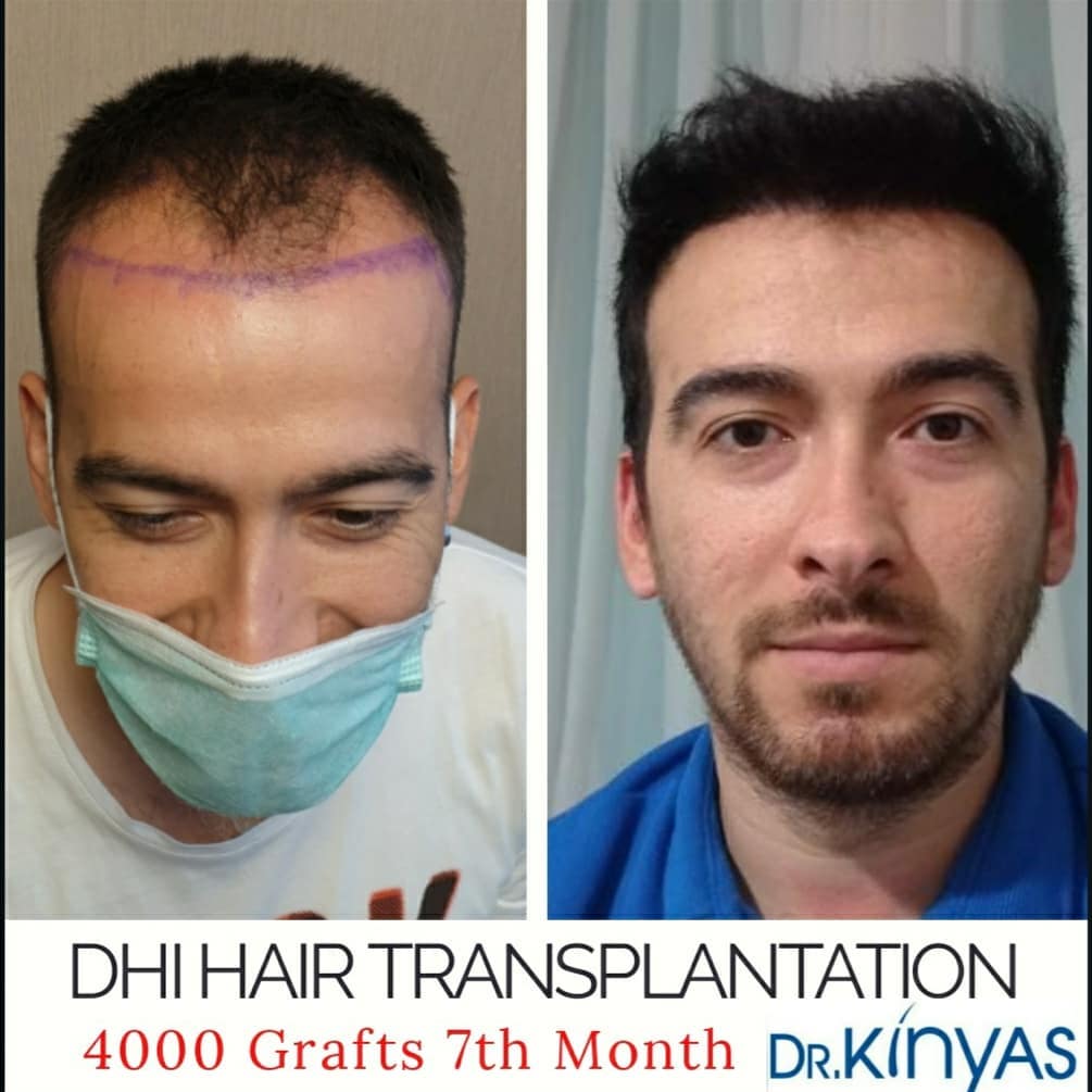 4000 GRAFT 7 MONTHS RESULTS
