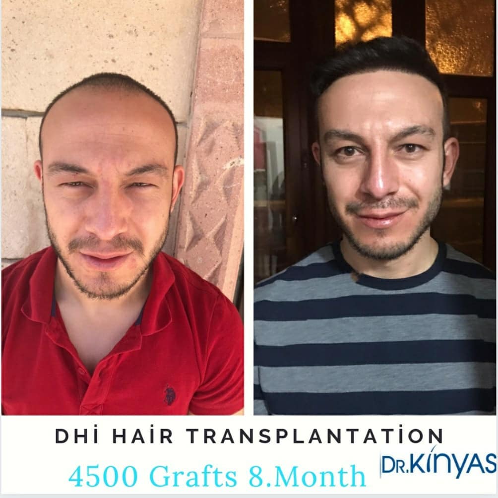 4500 GRAFT 8 MONTHS RESULTS