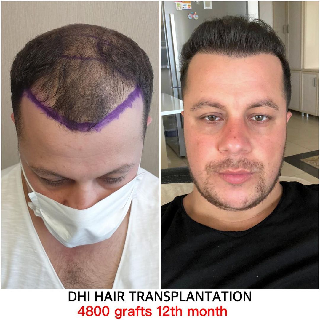 4800 GRAFT 12 MONTHS RESULTS