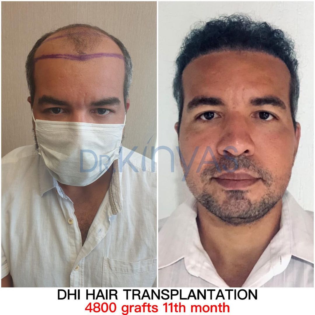 4800 GRAFT 11 MONTHS RESULTS