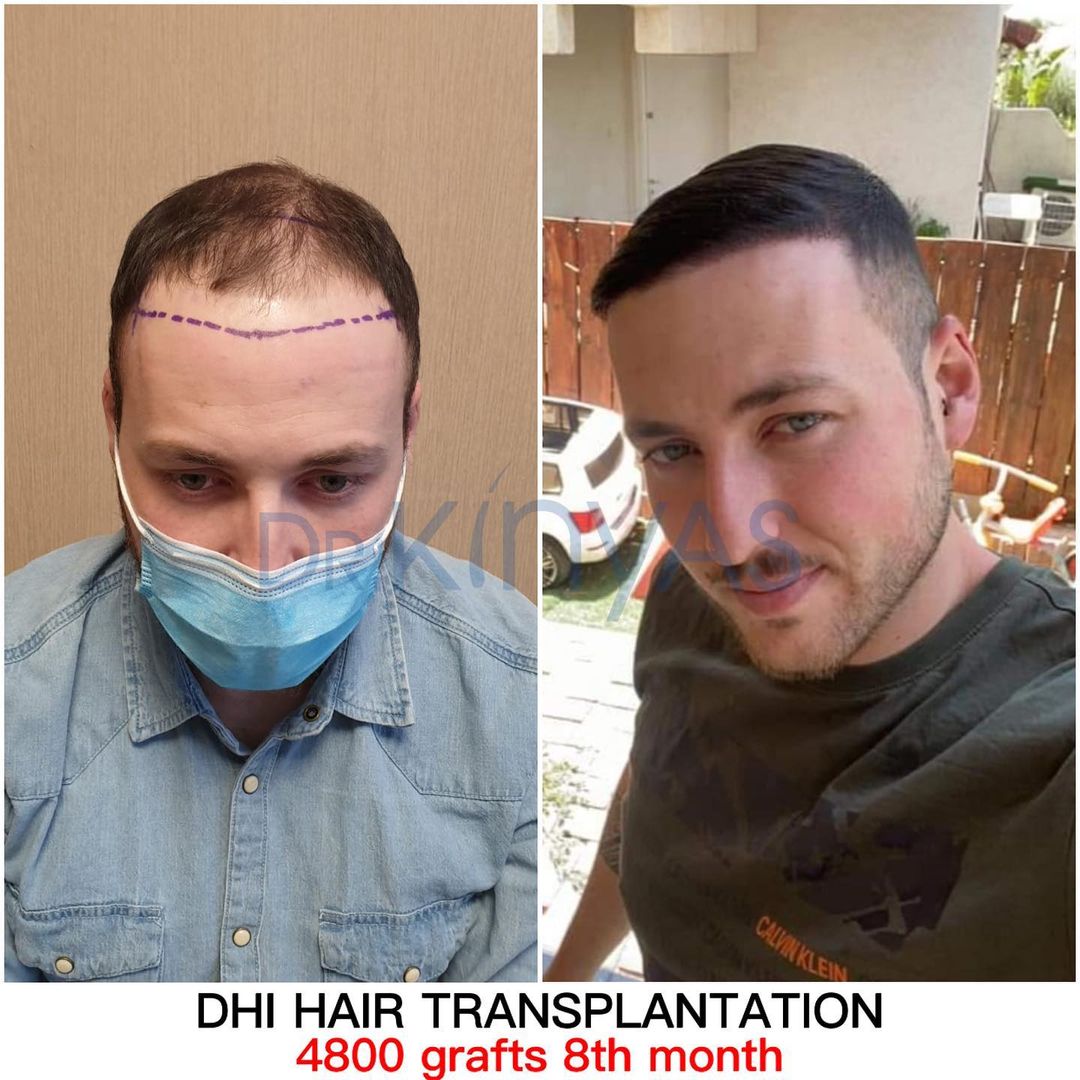 4800 GRAFT 8 MONTHS RESULTS