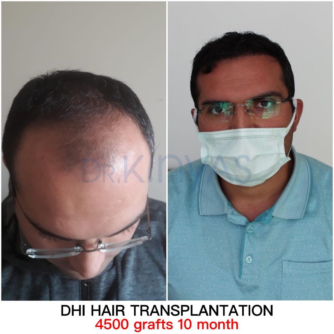  4500 GRAFT 10 MONTHS RESULTS
