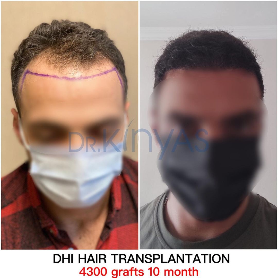  4300 GRAFT 10 MONTHS RESULTS