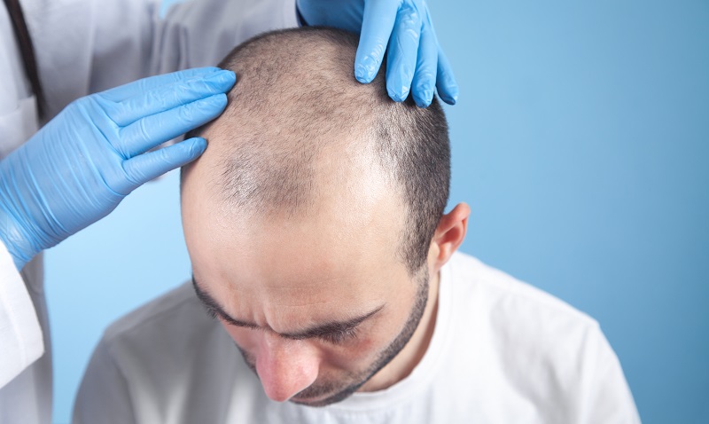 Hair Transplantation with FUE Technique