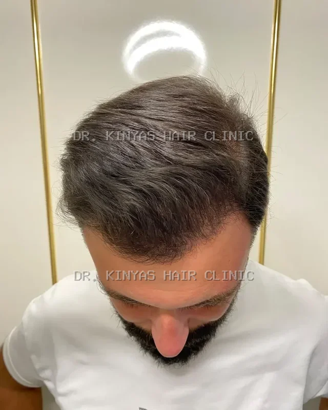 DOPO