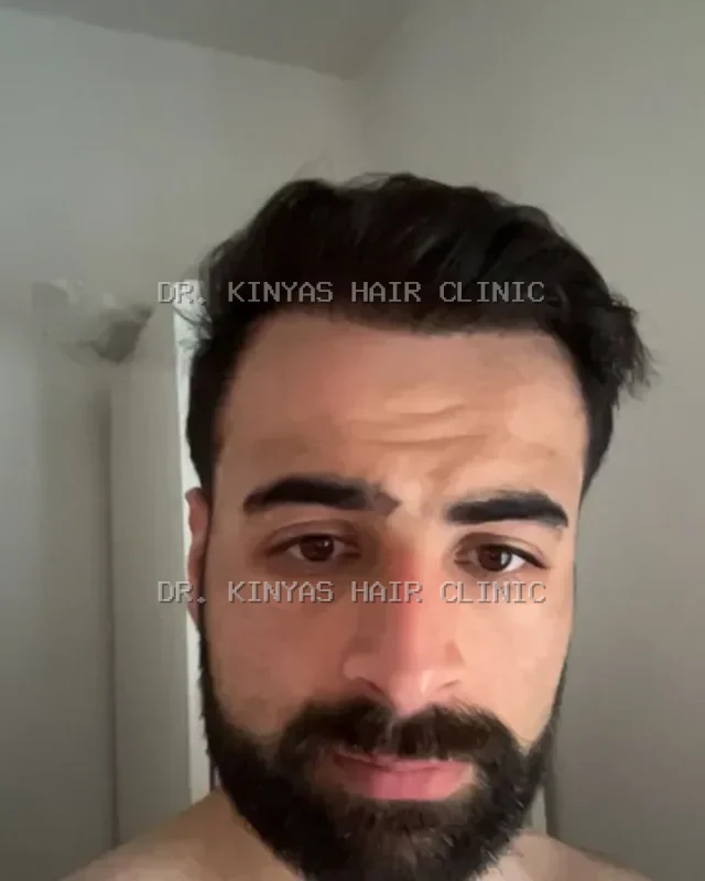 DOPO