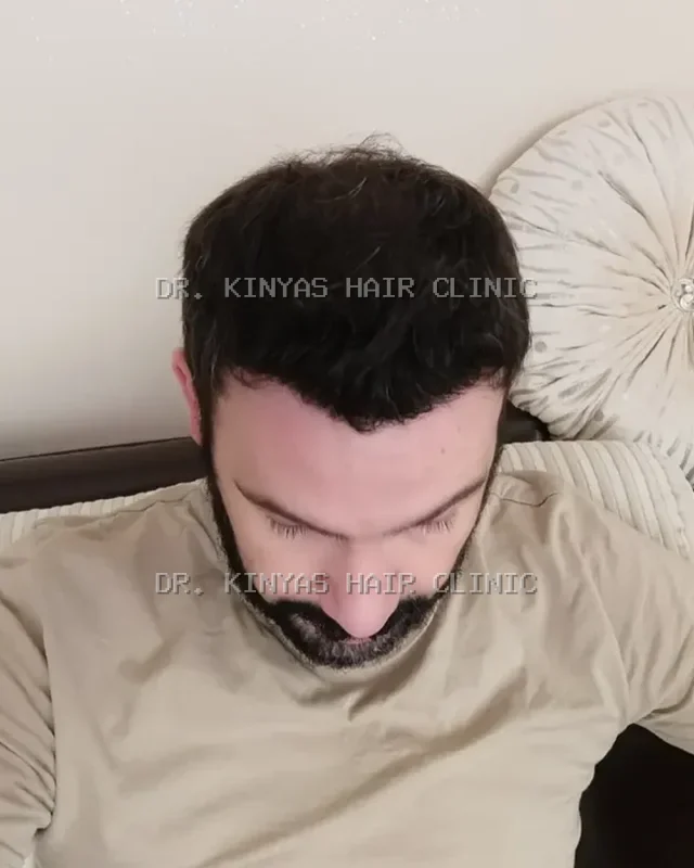 DOPO