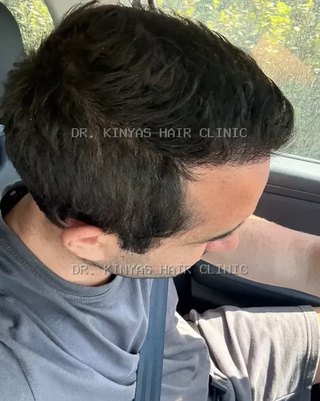 DOPO