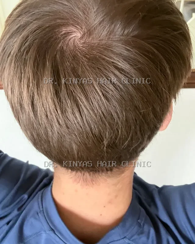 DOPO