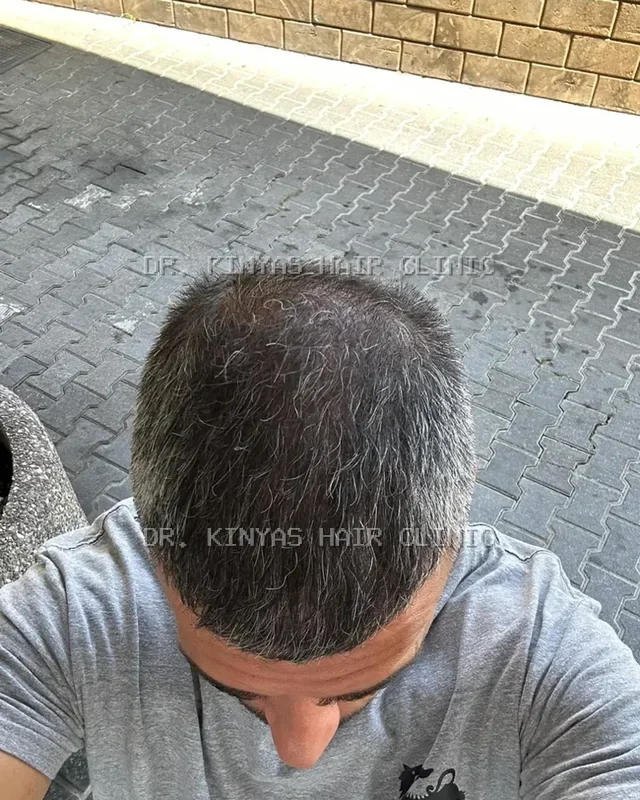 DOPO