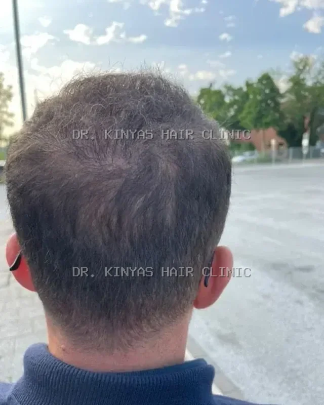 DOPO