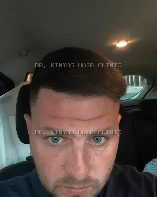 DOPO