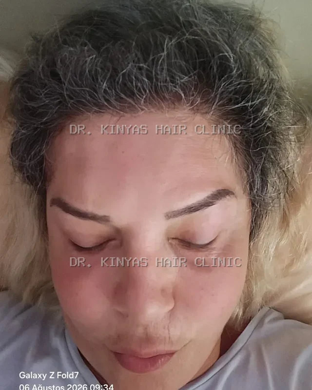 DOPO