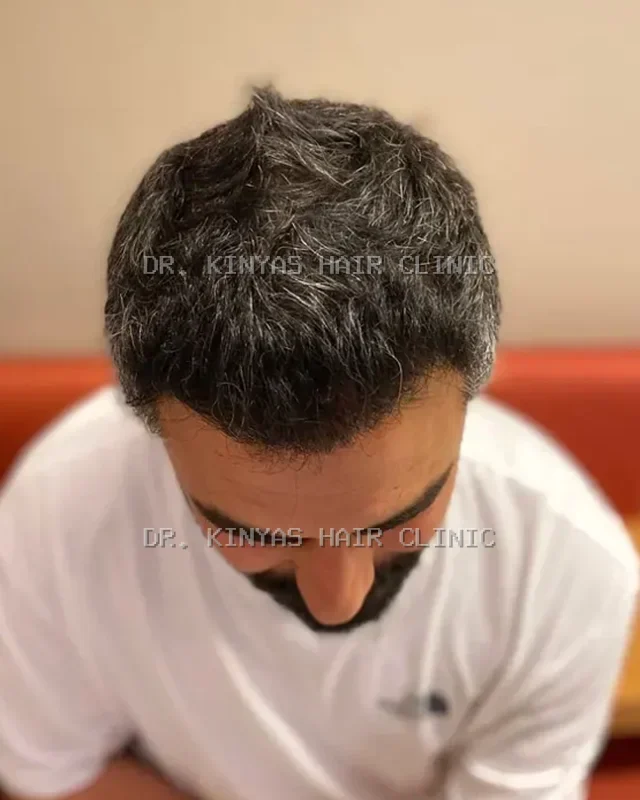 DOPO