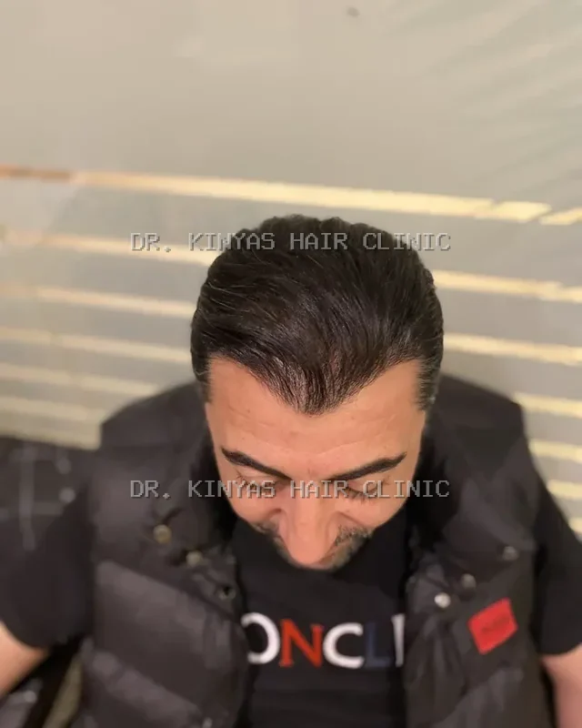 DOPO